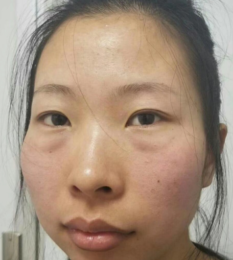 去眼袋手术