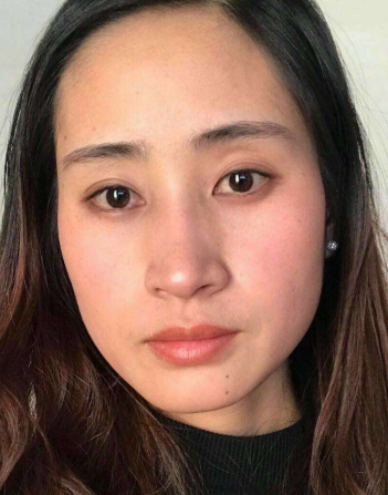 去眼袋手术