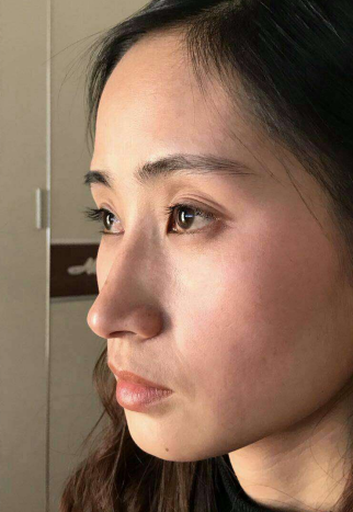 去眼袋手术