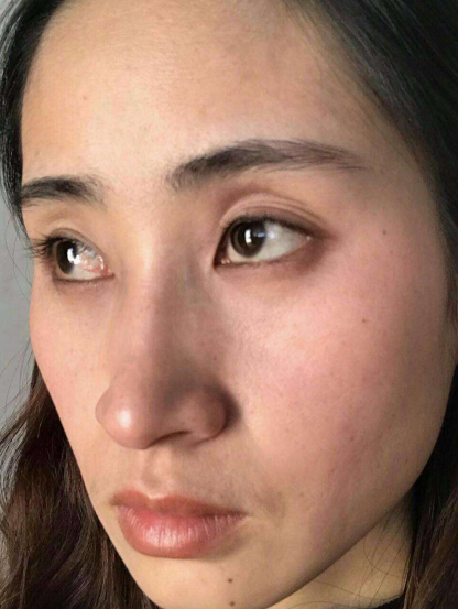 去眼袋手术