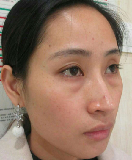 去眼袋手术