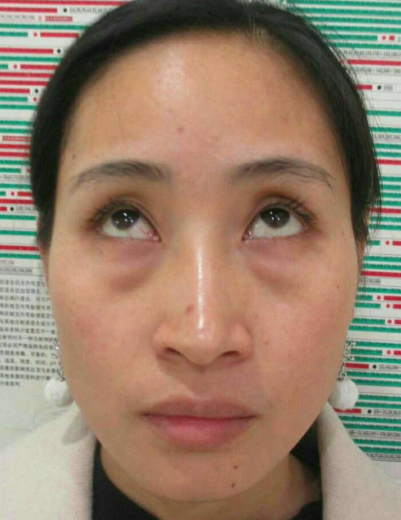去眼袋手术