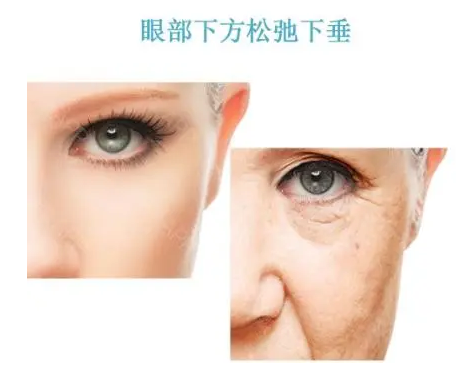 去眼袋手术