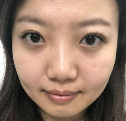 去眼袋手术