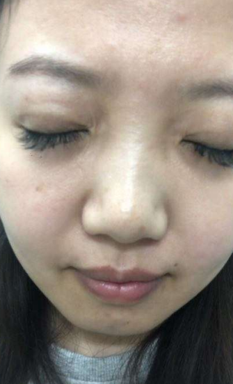 去眼袋手术