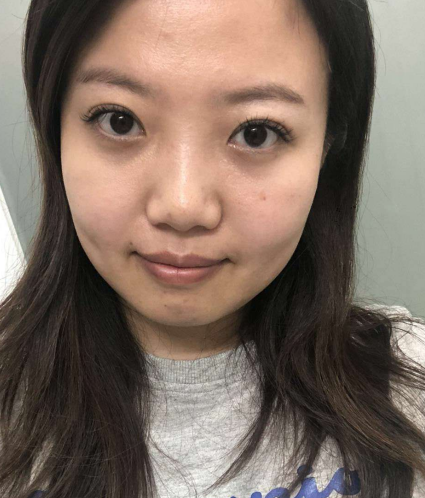 去眼袋手术