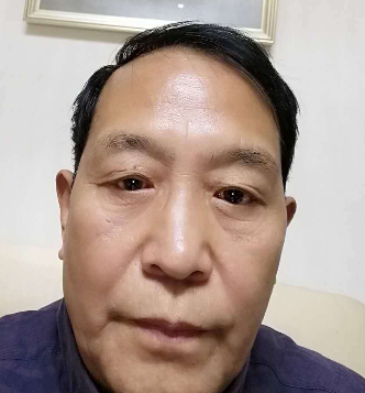 去眼袋手术