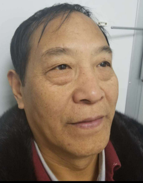 去眼袋手术