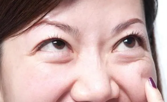 去眼袋手术