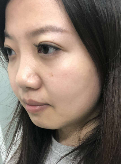 去眼袋手术