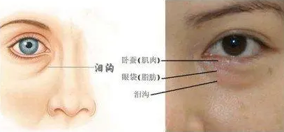 去眼袋手术