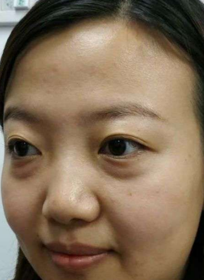 去眼袋手术