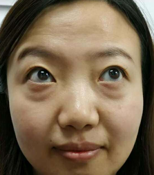去眼袋手术