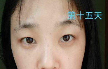 去眼袋手术