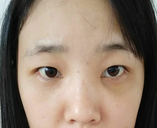 去眼袋手术