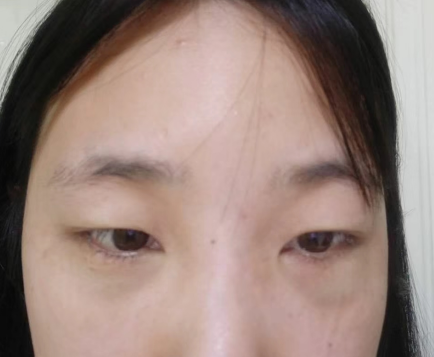 去眼袋手术