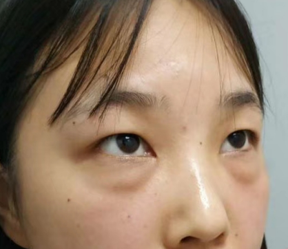 去眼袋手术