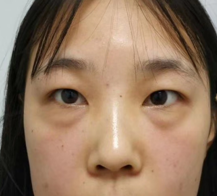 去眼袋手术