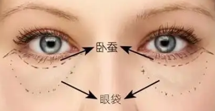 去眼袋手术