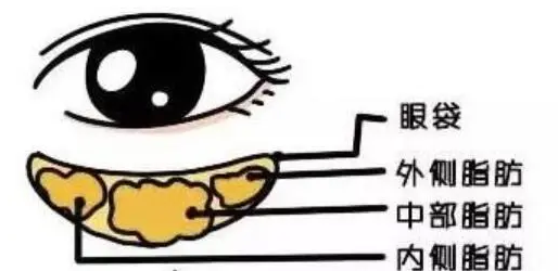 去眼袋手术