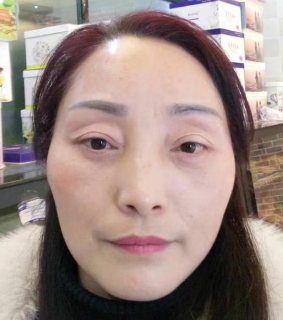去眼袋手术