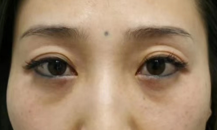 眼袋
