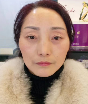 去眼袋手术