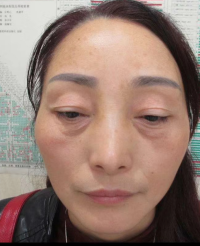 去眼袋手术