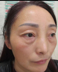 去眼袋手术