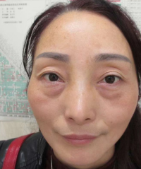 去眼袋手术