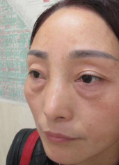 去眼袋手术