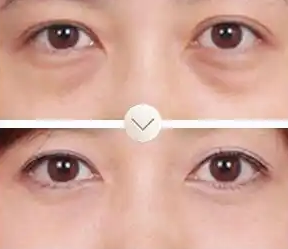 眼袋
