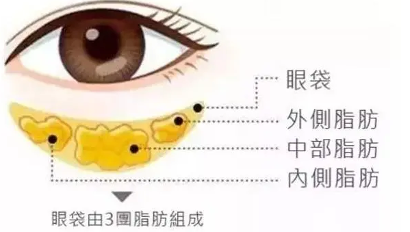 去眼袋手术