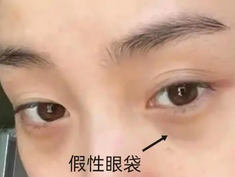 去眼袋手术