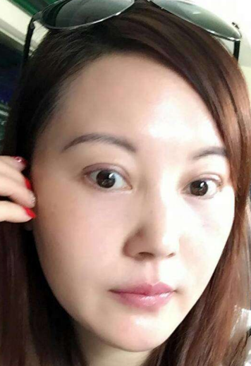 去眼袋手术