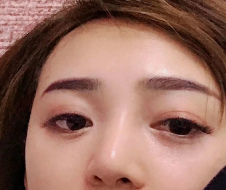 去眼袋手术