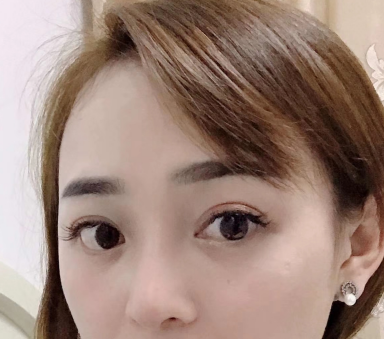 去眼袋手术