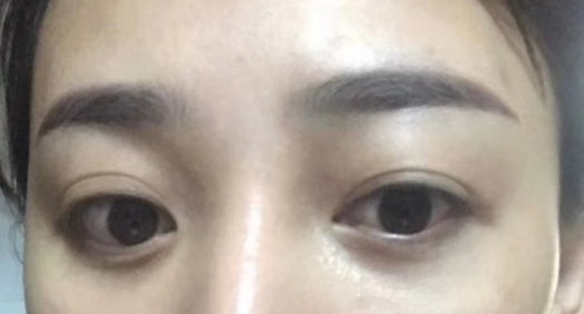 去眼袋手术