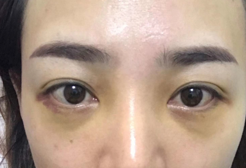去眼袋手术