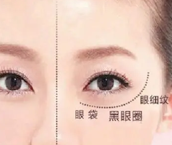 去眼袋手术