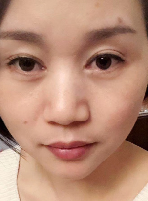 去眼袋手术