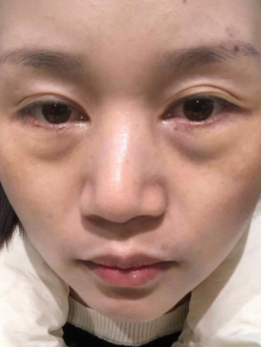 去眼袋手术