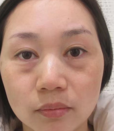 去眼袋手术