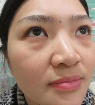去眼袋手术