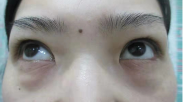 去眼袋手术