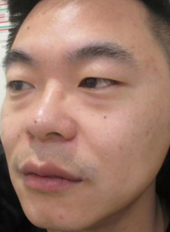 去眼袋手术