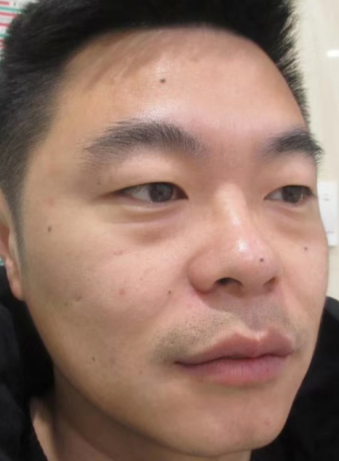去眼袋手术