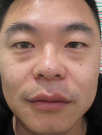去眼袋手术