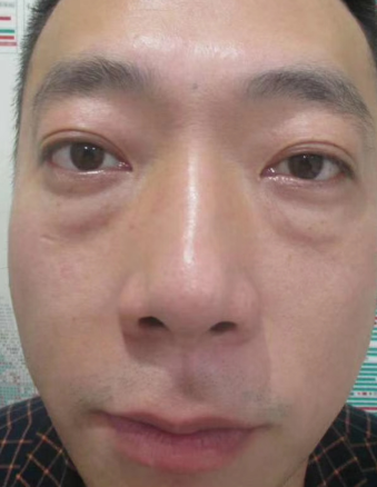去眼袋手术