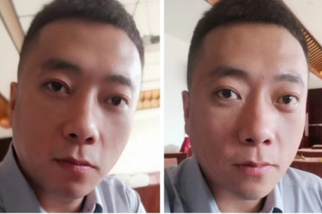 去眼袋手术